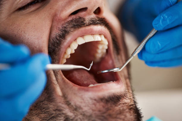 Best Emergency Wisdom Tooth Extraction in Norton, OH